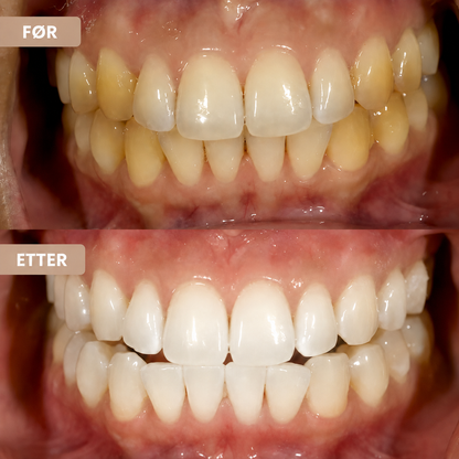 Whitening tannkrem – Reduser misfarging